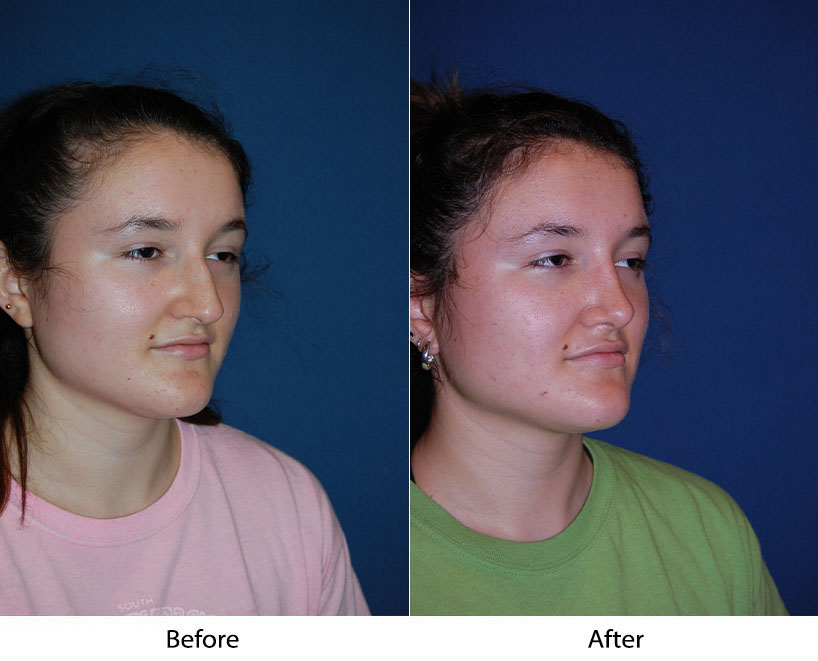Woman's three-quarter view before and after facial procedure, showing nose and chin definition