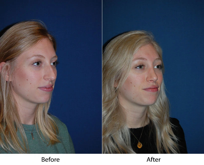 Before and after profile facial comparison showing patient in teal shirt on left and black shirt on right