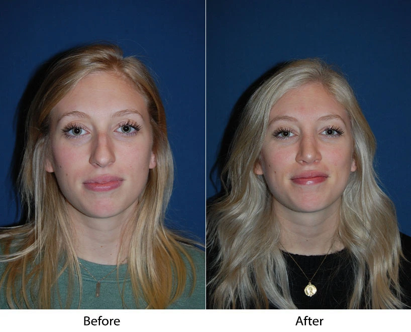 Before and after frontal facial comparison showing patient in teal shirt on left and white shirt on right