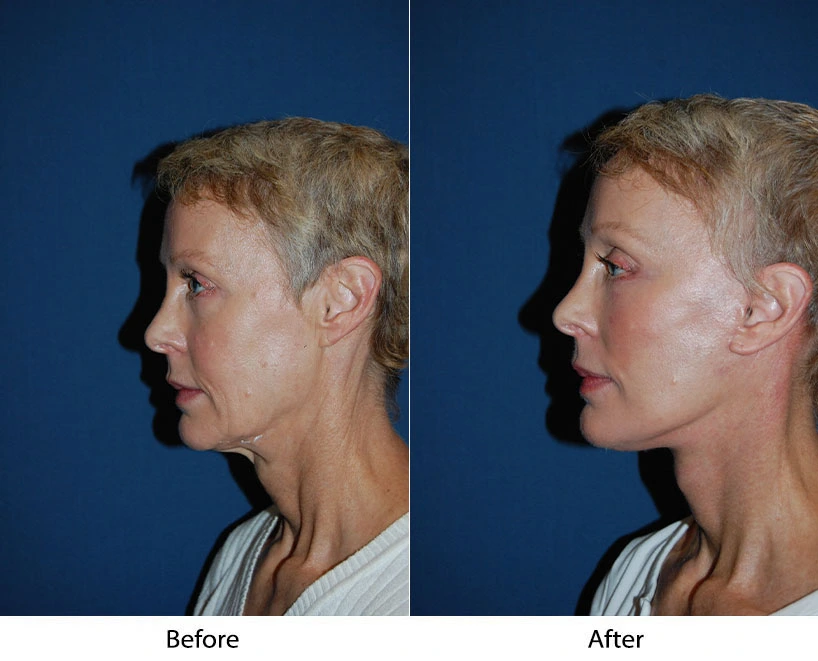 7608-1