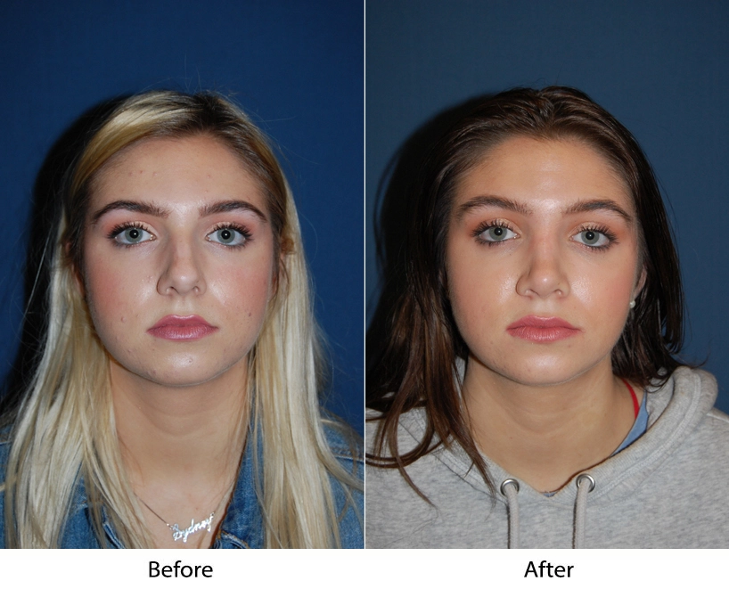 Side-by-side front-facing comparison: before shows rounder face, after shows more defined facial structure