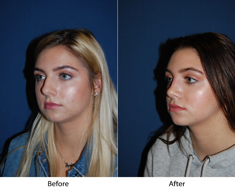 Side-by-side front-facing comparison: before shows fuller face, after shows more contoured cheekbones