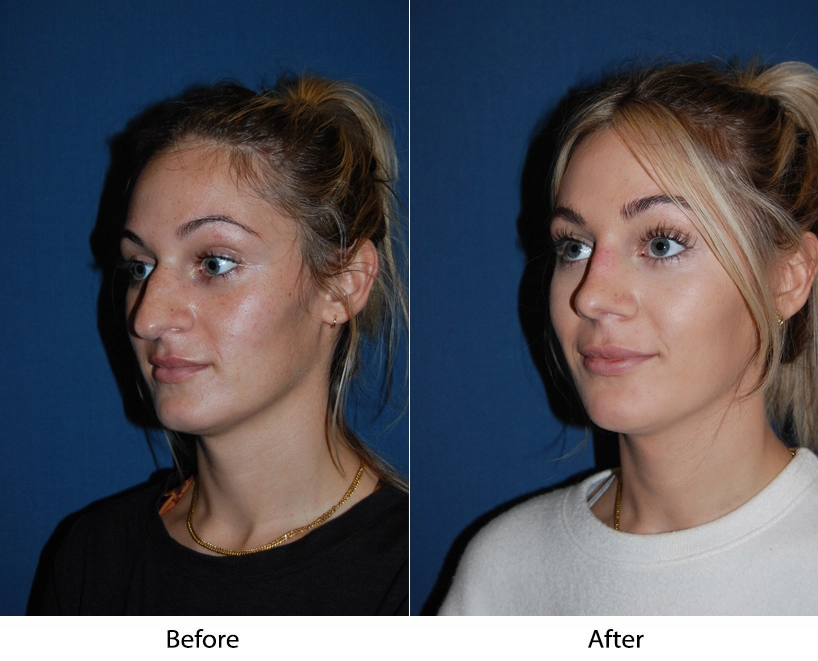 Patient three-quarter view before and after procedure, showing facial profile refinement