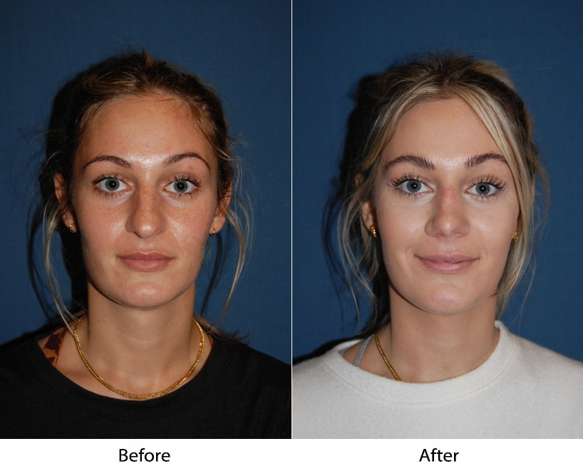 Patient frontal view before and after procedure, showing facial symmetry and definition changes