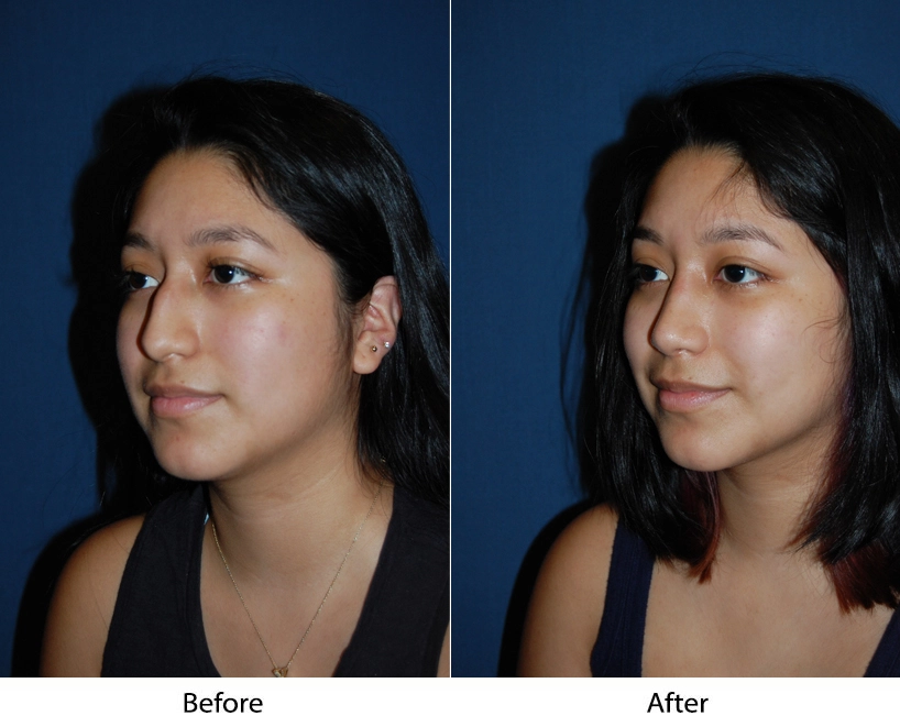 Before and after three-quarter views showing facial refinement results