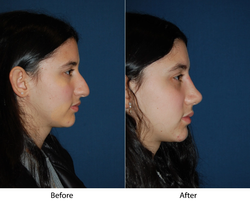 Before and after profile views showing rhinoplasty results