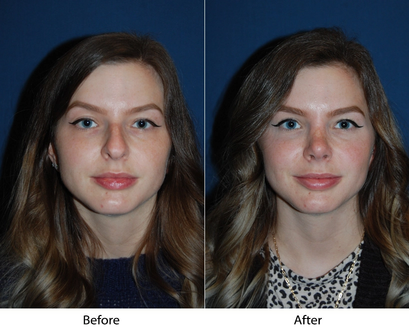 Before and after front-facing views showing rhinoplasty results