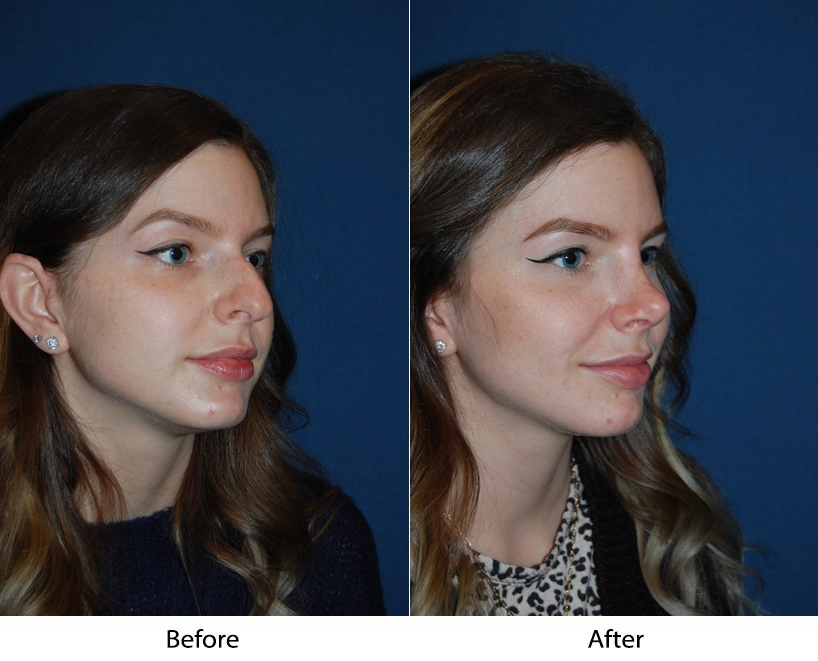 Before and after three-quarter profile views showing rhinoplasty results