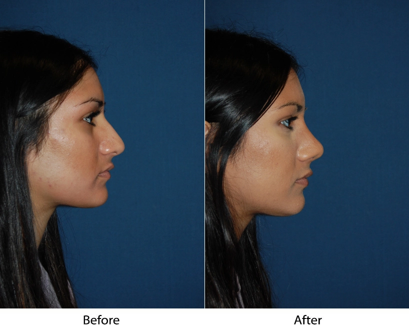 Before and after side profile views showing facial contouring results