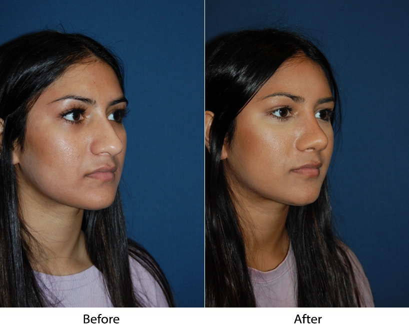 Before and after three-quarter view showing facial refinement results
