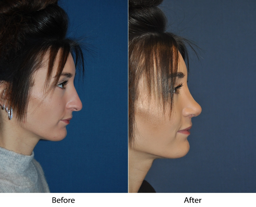 Patient side profile comparison showing before and after nasal and facial structure changes