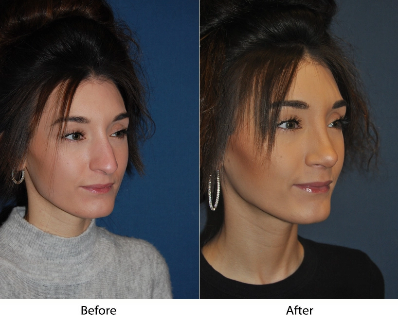 Patient profile comparison showing before and after nose and facial contour refinement