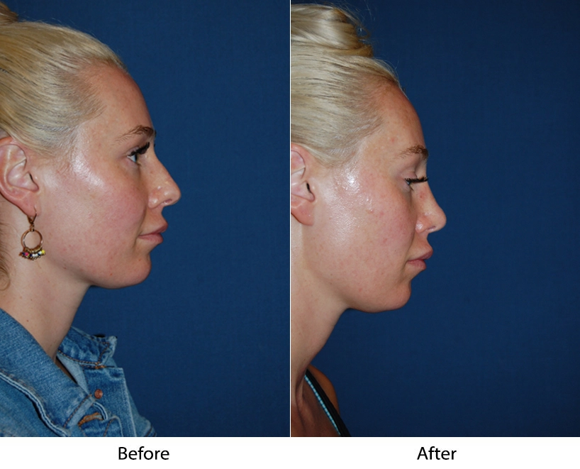 Before and after profile view of patient showing facial contouring results