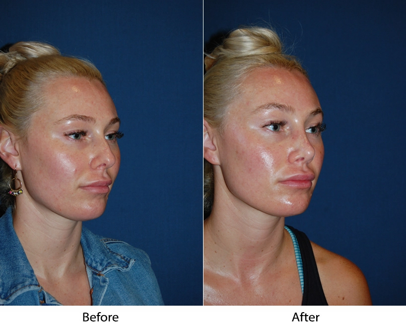Before and after three-quarter view of patient showing facial refinement results