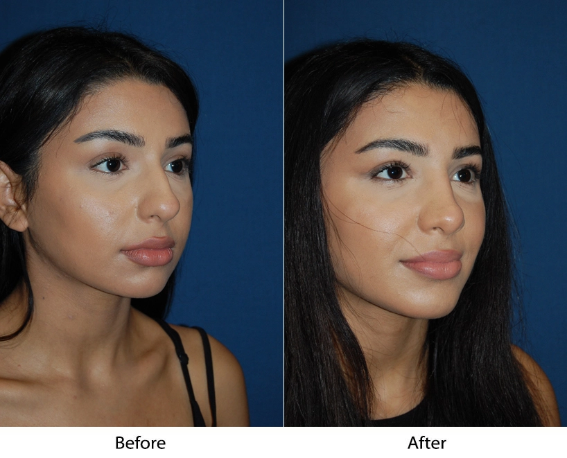 Before and after profile comparison showing side-facing facial views