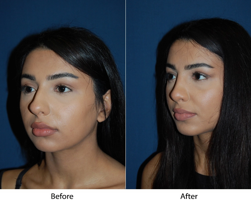 Before and after comparison showing frontal and three-quarter facial views