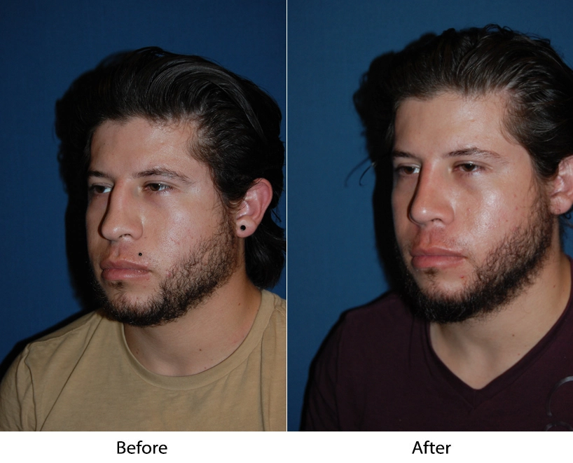 Man's three-quarter face view before and after showing improved facial contours