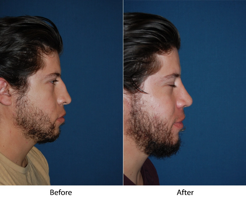 Man's profile before and after showing enhanced chin and jawline structure