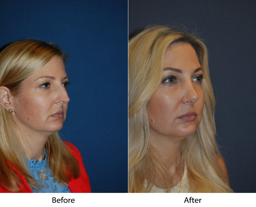 Before and after facial profile comparison showing patient's side and three-quarter views