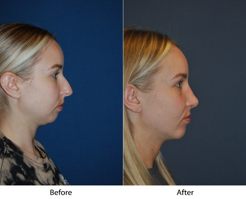 Before and after profile views showing patient's side-facing facial comparison