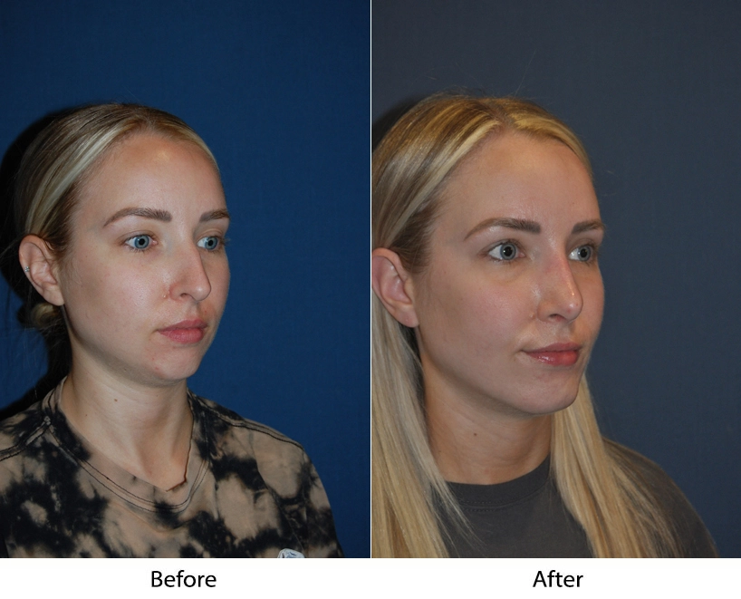 Before and after three-quarter facial views showing patient's facial changes