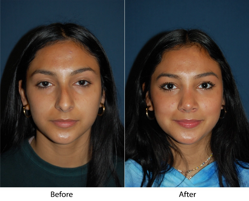 Before and after frontal facial comparison showing changes in facial contours and skin appearance