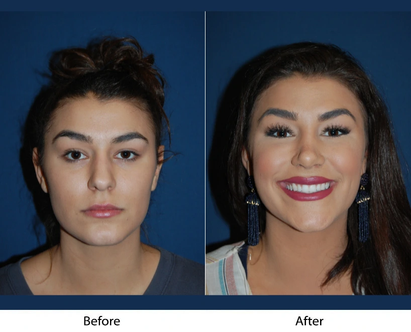 Before and after frontal facial comparison showing improved facial contours and skin appearance