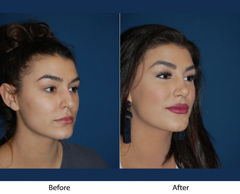 Woman's three-quarter profile before and after facial procedure, showing side-by-side comparison