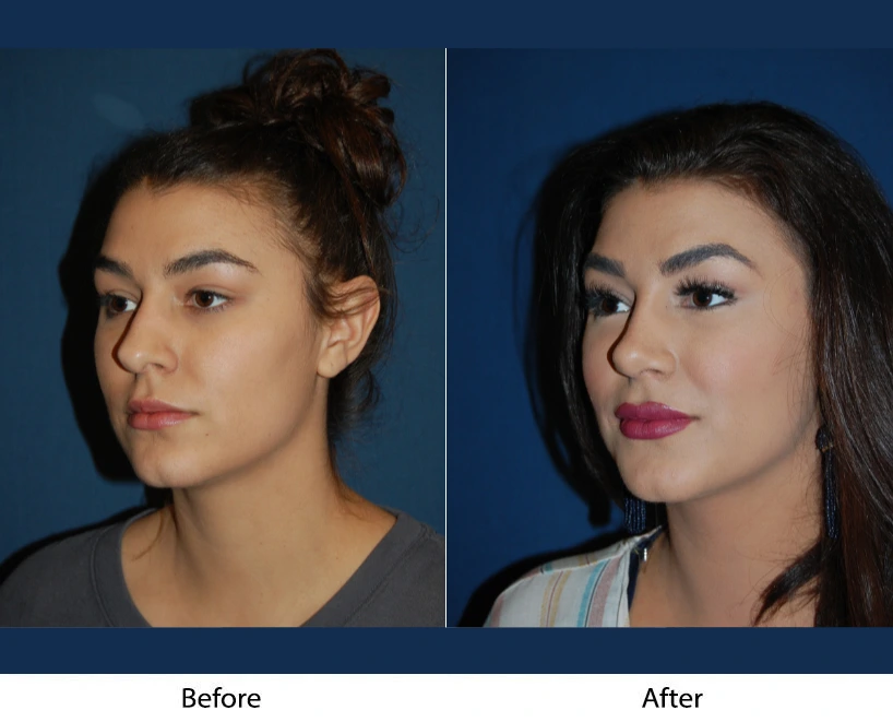 Woman's three-quarter profile before and after facial procedure, showing side-by-side comparison