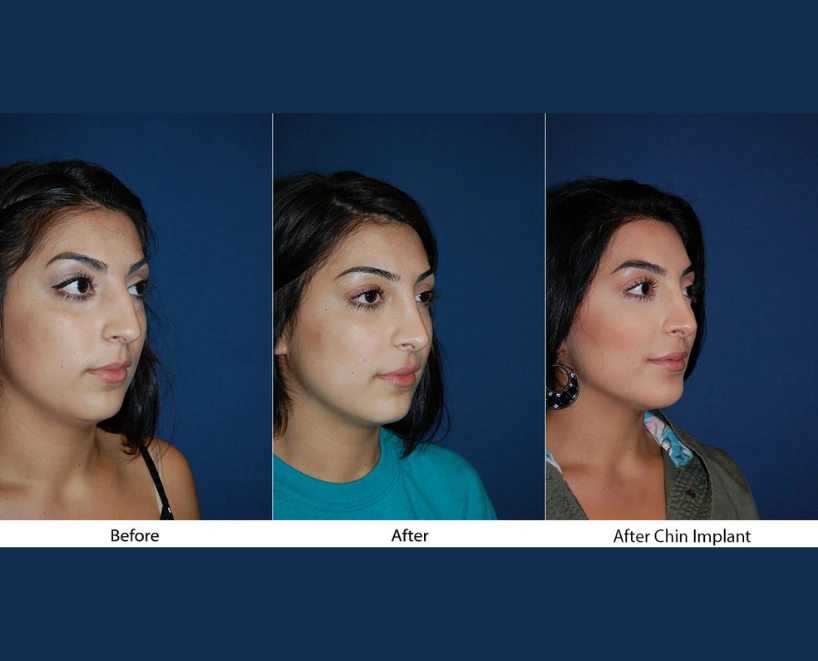 Woman's profile comparison: before, after, and after chin implant procedure