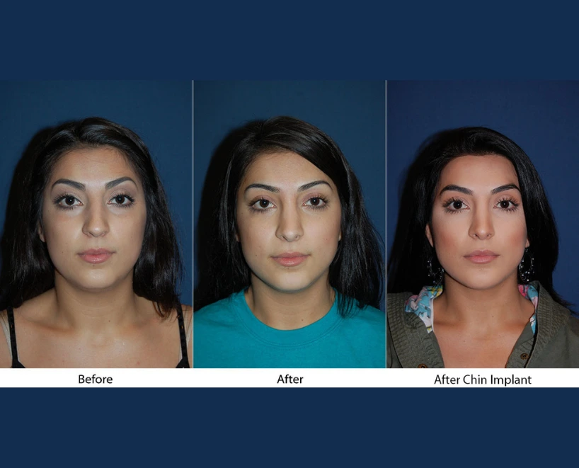 Woman's front-facing comparison: before, after, and after chin implant procedure
