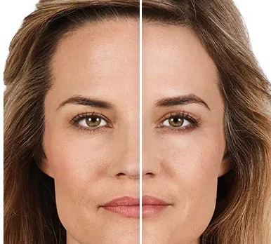 injectable-fillers-before-and-after-juvederm