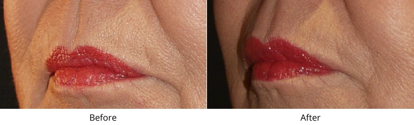 Lip Implants Before & After Banner