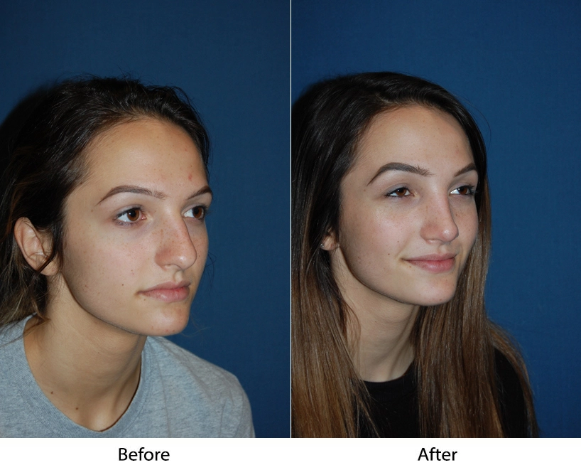 Before and after three-quarter views of woman's face showing facial harmony improvement