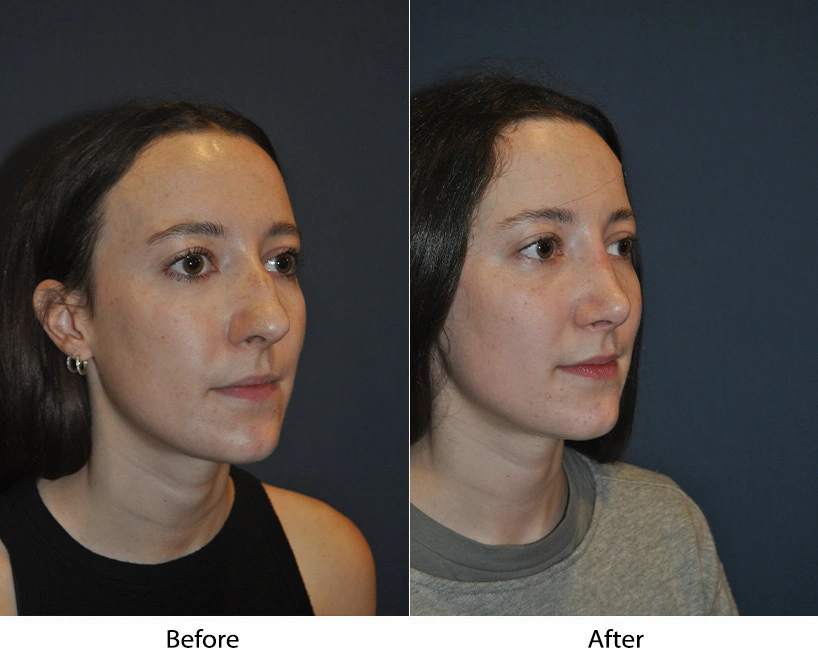 Before and after profile views showing enhanced facial contours and chin definition