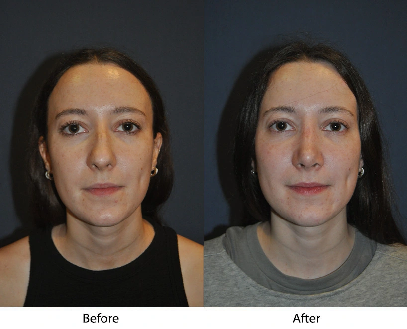 Before and after frontal face photos showing improved facial balance and definition