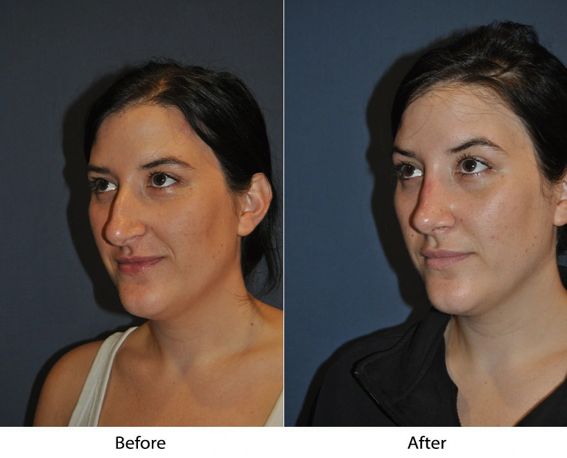 Before and after three-quarter views showing improved facial definition and balance