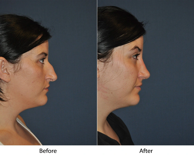 Before and after profile views showing refined nasal structure and chin enhancement