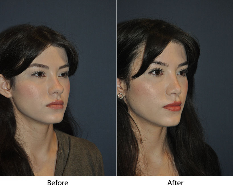 Before and after three-quarter view showing cheek and facial definition