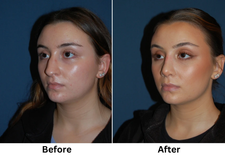 Before and after three-quarter view showing facial sculpting with enhanced cheekbones and refined profile