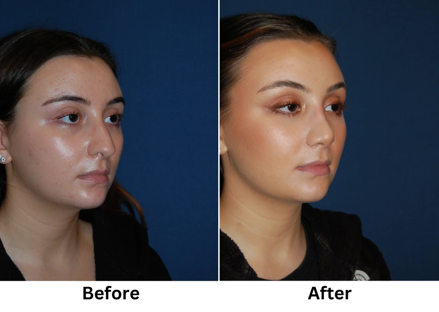 Before and after three-quarter view showing facial contouring results with improved cheek definition and jawline