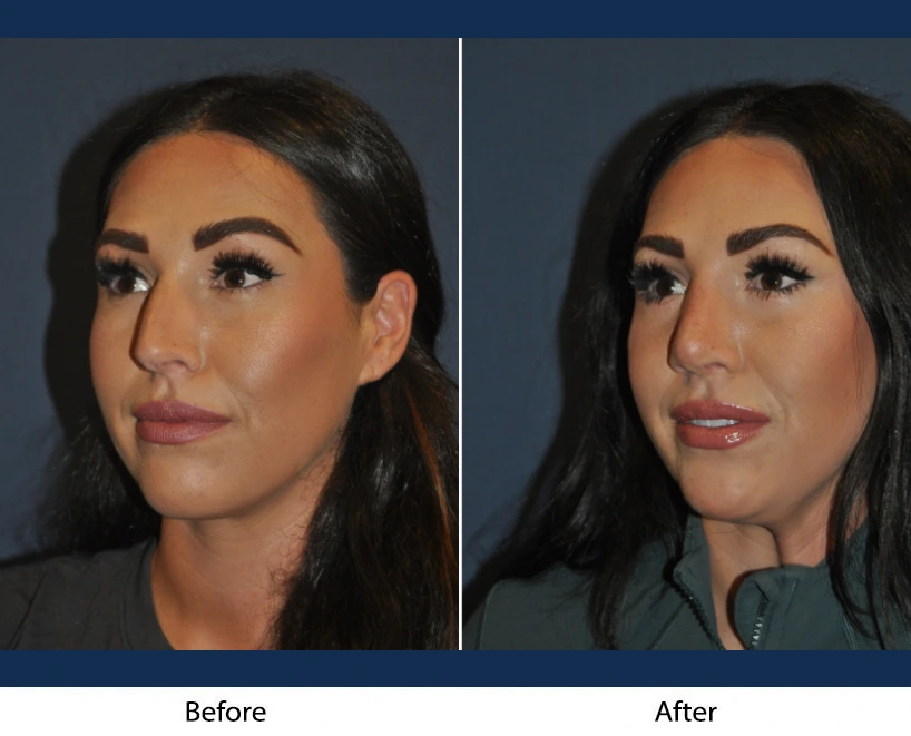 Before and after facial comparison showing woman's face from three-quarter angle