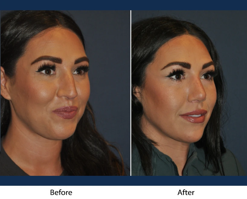 Before and after facial comparison showing woman's face from front angle