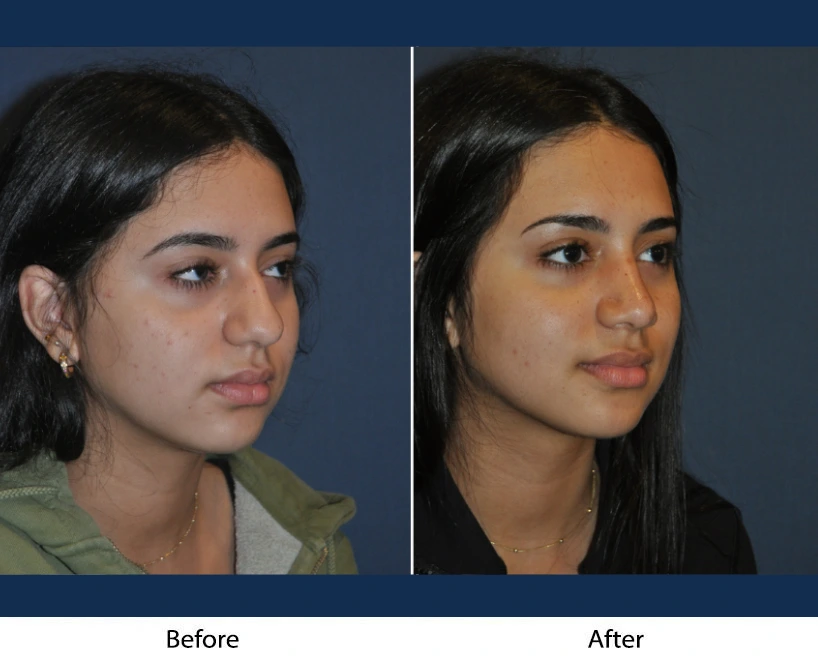 Woman's three-quarter view before and after facial procedure, showing side-by-side comparison