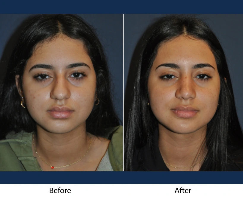 Woman's front-facing view before and after facial procedure, showing side-by-side comparison