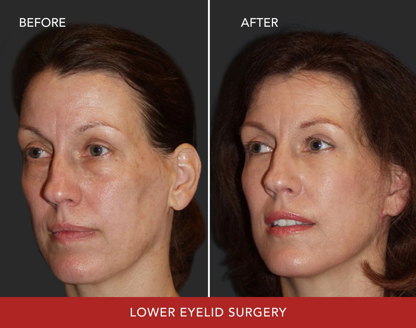 Lower eyelid surgery before and after comparison, female patient profile view