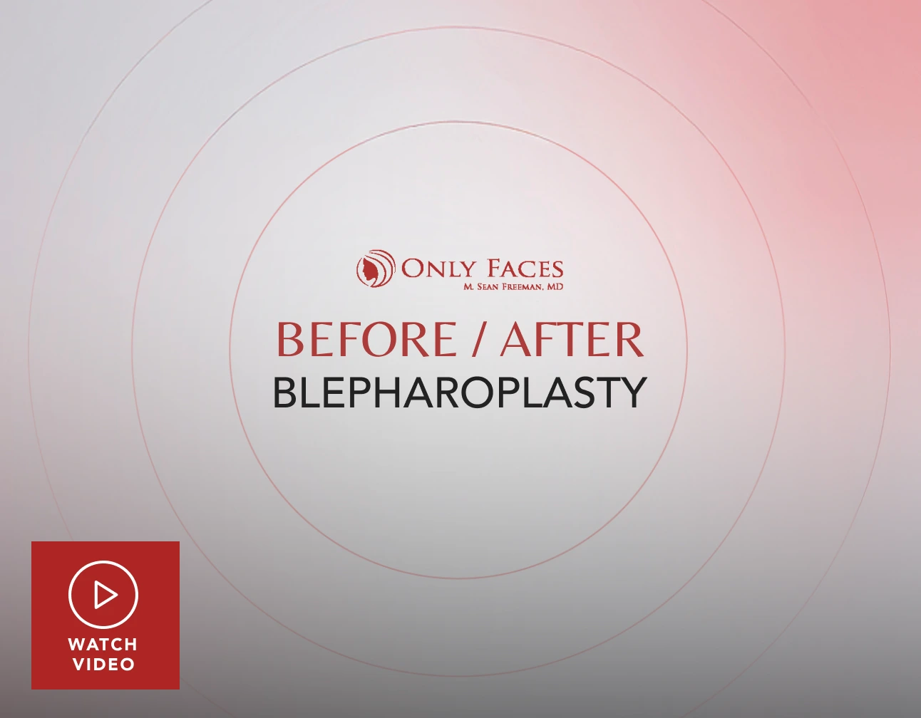 Only Faces logo with text Before/After Blepharoplasty and Watch Video button
