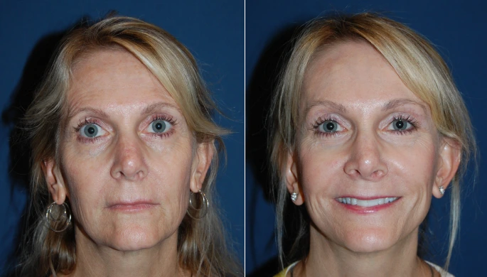 Category I Brow Lift before and after photo, front view, by Dr. Sean Freeman in Charlotte, NC