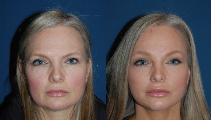 Category II Brow Lift before and after photo, front view, by Dr. Sean Freeman in Charlotte, NC