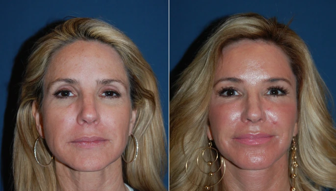 Category III Brow Lift before and after photo, front view, by Dr. Sean Freeman in Charlotte, NC